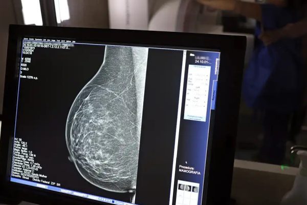 mamografia